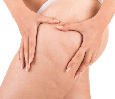 cellulite-reduction-treatment-01